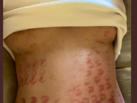 除毛搞得一身伤!宝生リリー(宝生莉莉)恐生涯终结!